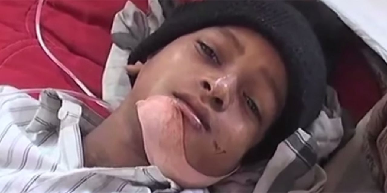 Doktori iz usta sedmogodišnjeg dječaka izvadili 80 zuba