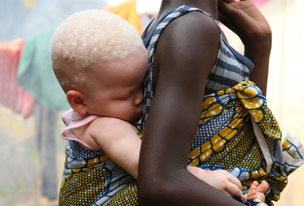 Tanzanija: Zabranjeno vračanje zbog napada na albino populaciju