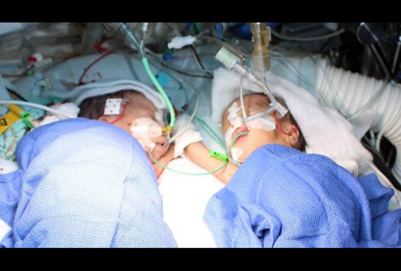Liječnici razdvojili dosad najmlađe sijamske blizance