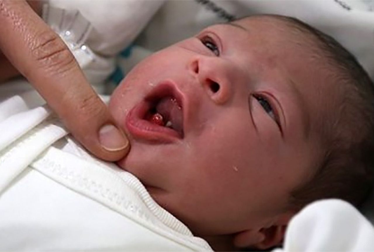 Turska: Rođena beba s dva prednja zuba