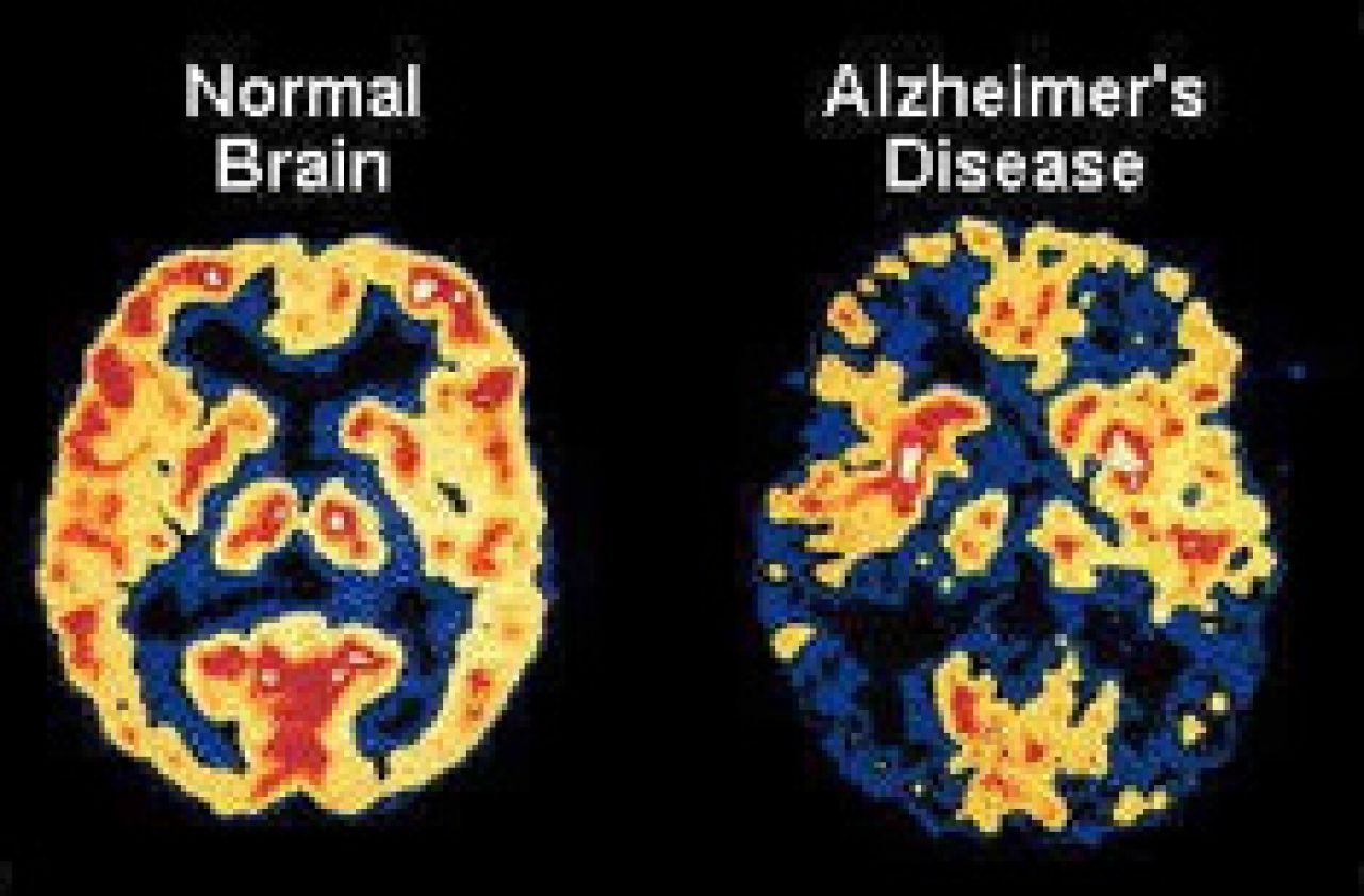 Razvijen revolucionarni lijek protiv Alzheimera