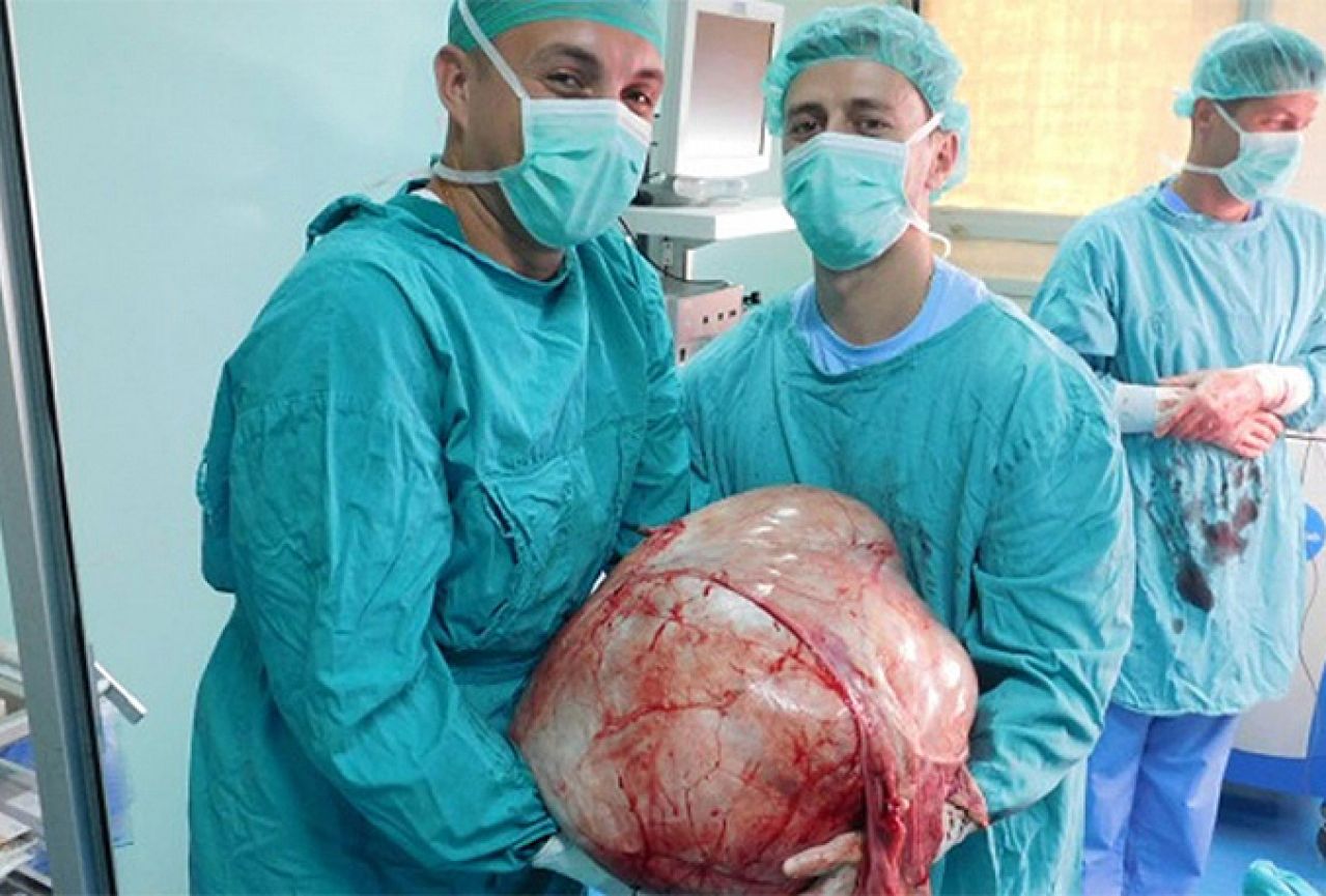 Banjalučki doktori odstranili tumor težak 31 kilogram  
