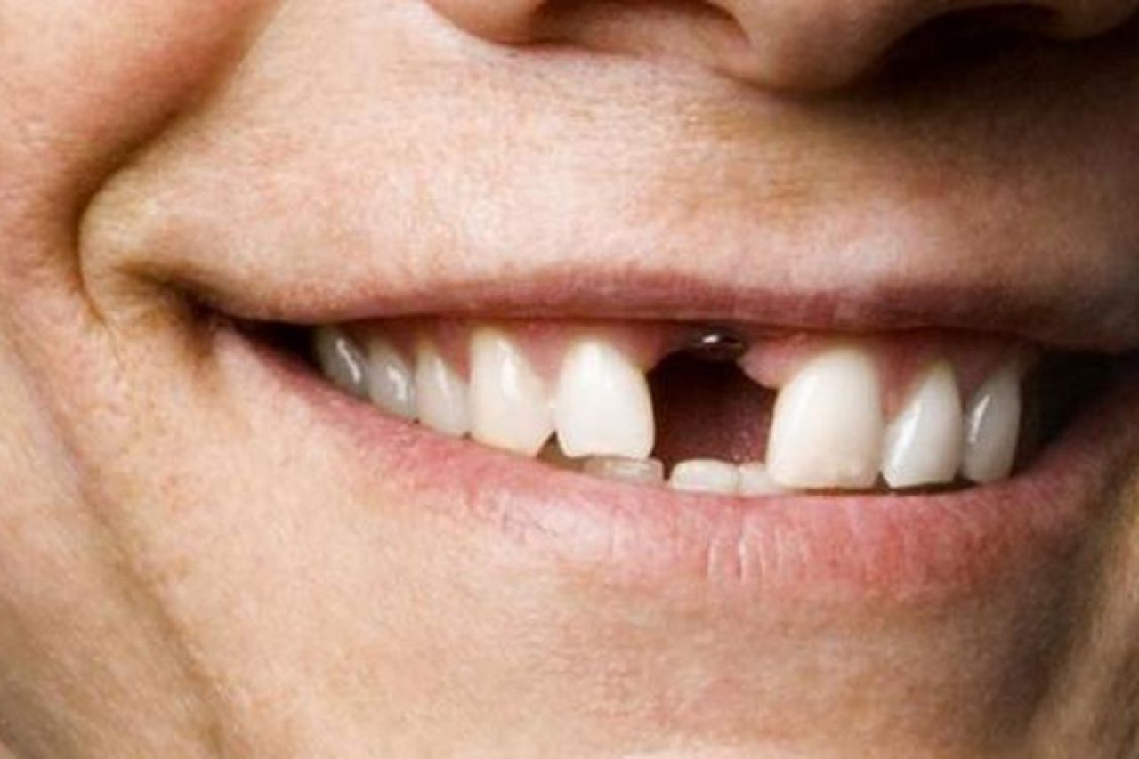 VIDEO | Zaboravite implantate! Zubi će vam izrasti za devet tjedana