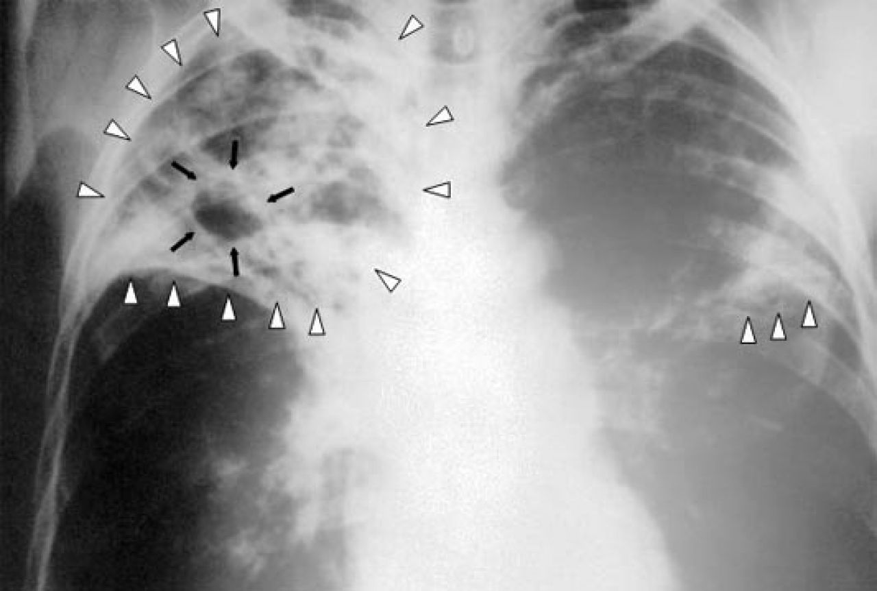 Manje umrlih od tuberkuloze