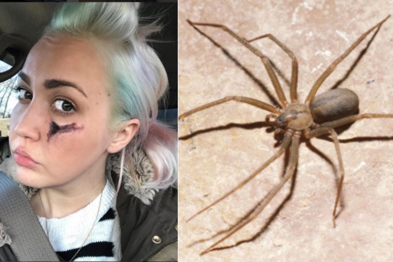 Brown Recluse Spider Bite Facts - Meghan Linsey Bitten By Poisonous Brown  Recluse Spider
