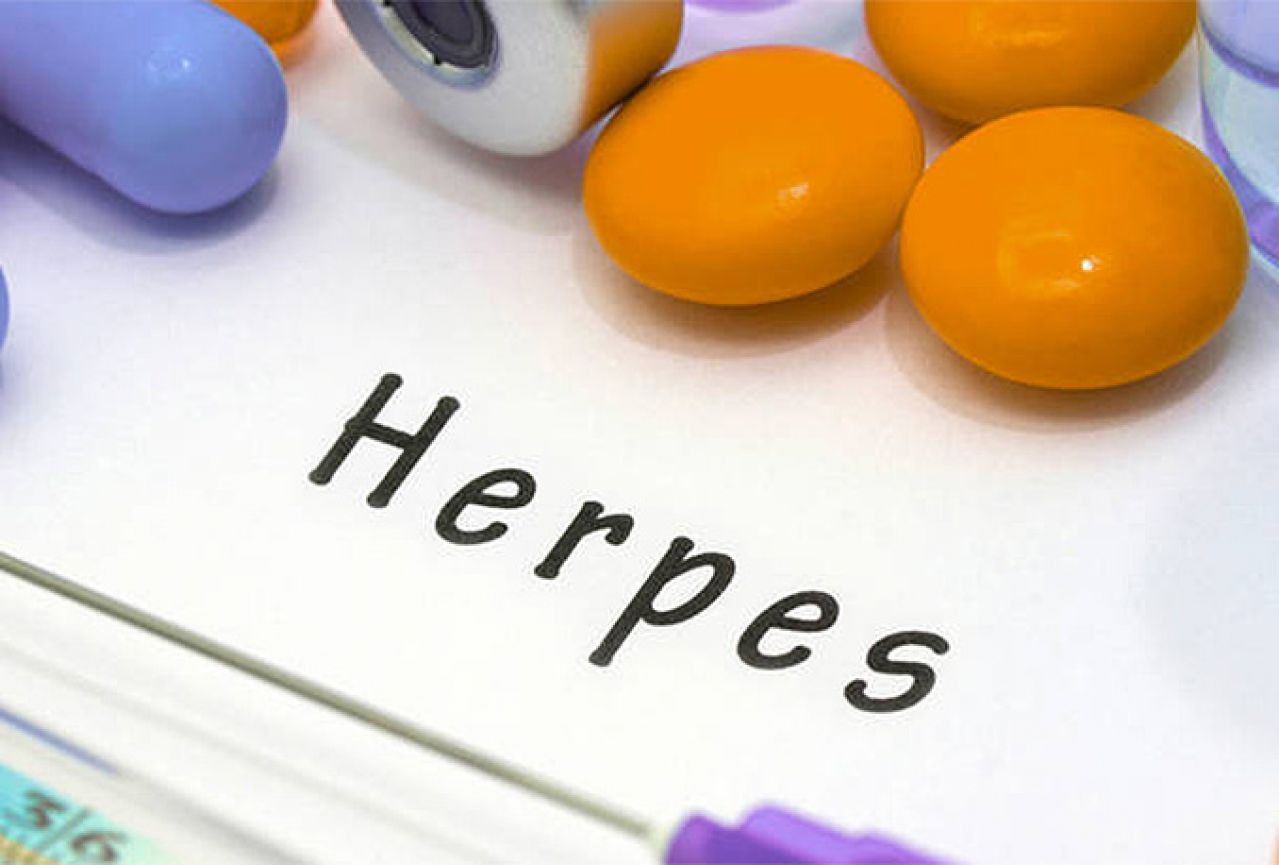 Pet prirodnih lijekova za herpes zoster