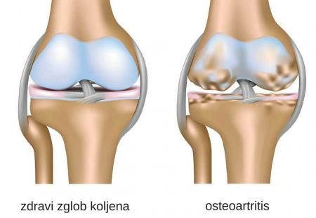 https://storage.bljesak.info/article/327607/450x310/Osteoartritis.jpg