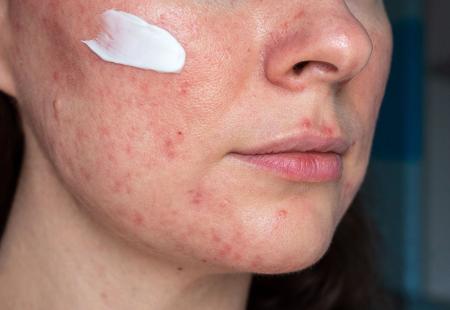 https://storage.bljesak.info/article/474296/450x310/rosacea.jpg