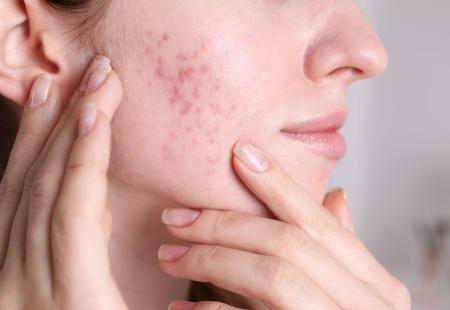 https://storage.bljesak.info/article/478515/450x310/rosacea.jpg