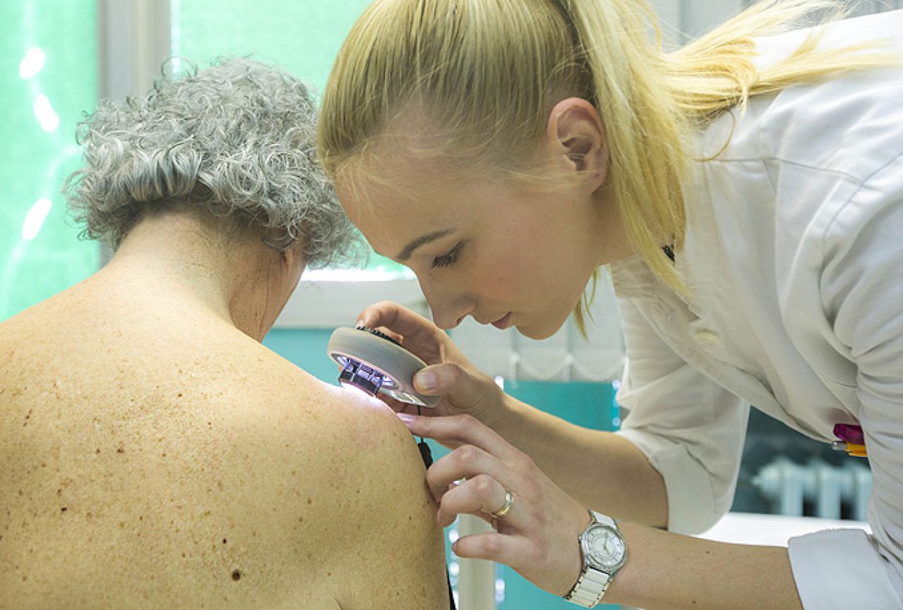 Broj oboljelih od raka kože i malignog melanoma se udvostručio u posljednjih pet godina