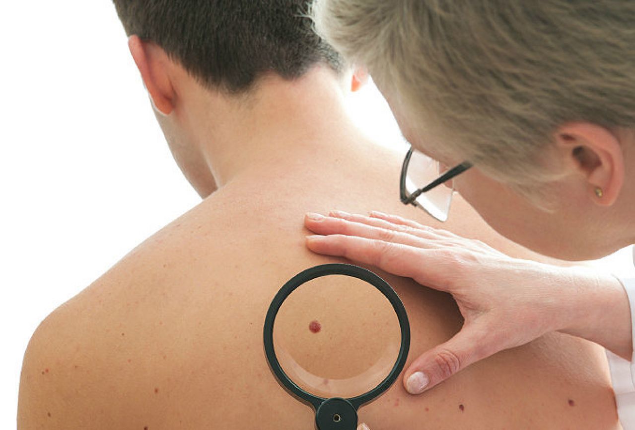 BiH nema jedinstveni registar oboljelih od melanoma