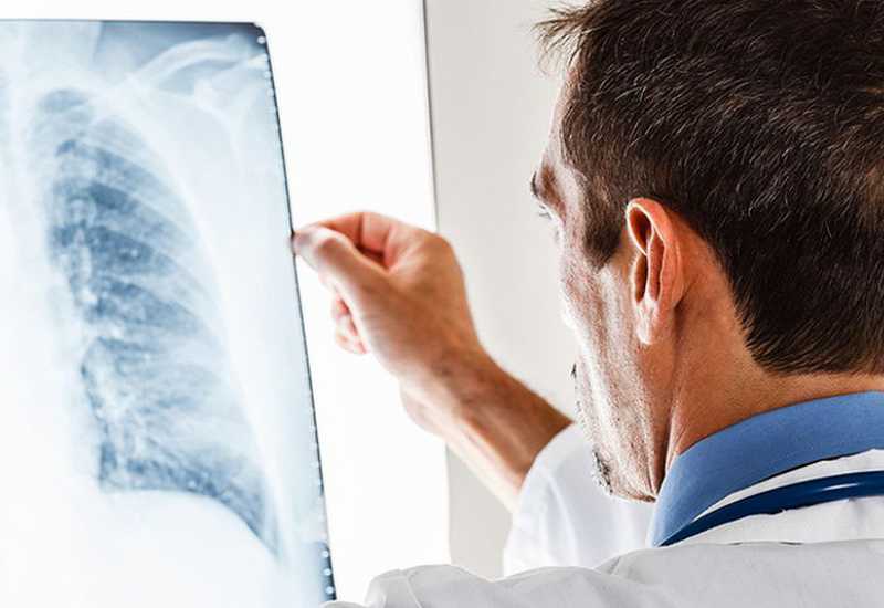 WHO uputio nove preporuke za prevenciju tuberkuloze