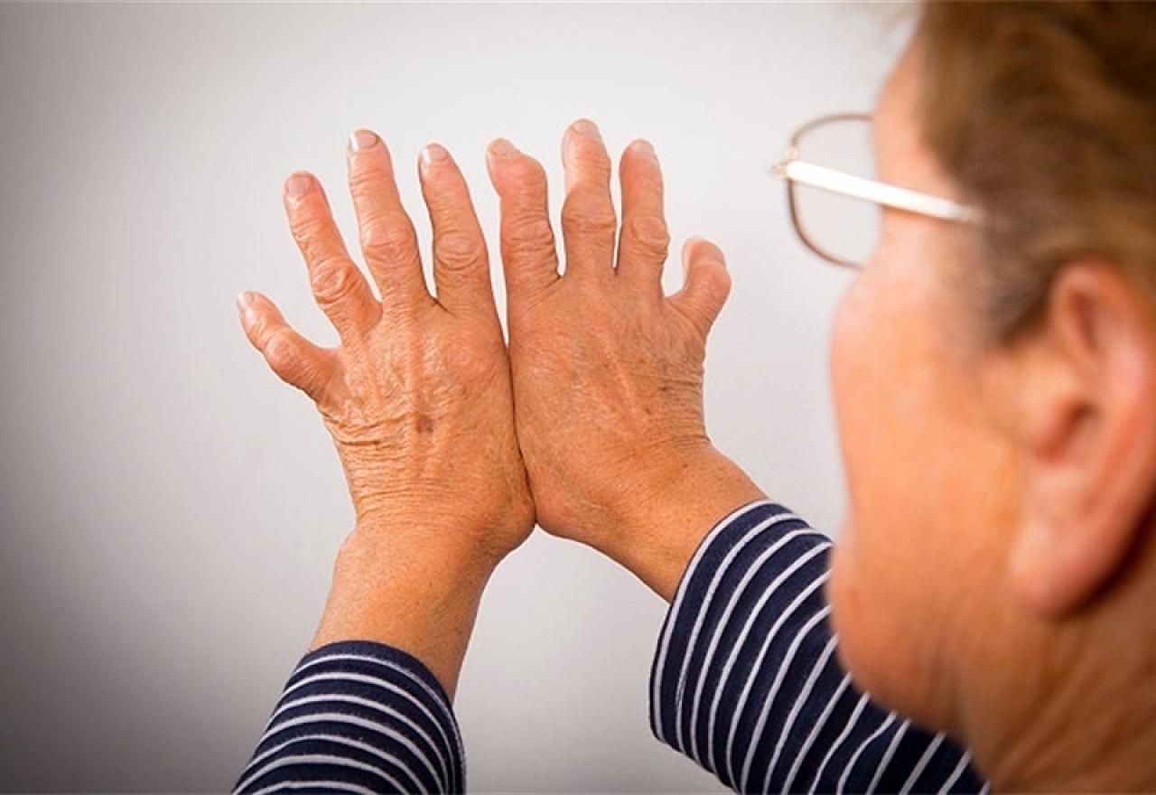 Пациентов с сопутствующими заболеваниями. Ревматоидный артрит руки. Артрит врач.
