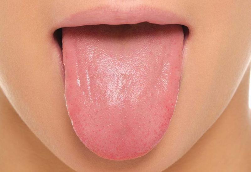Promjena boje jezika otkrit će infekcije i nedostatak vitamina