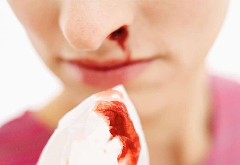 Znate li zašto ponekad iznenada dolazi do krvarenja iz nosa i kako ga zaustaviti?