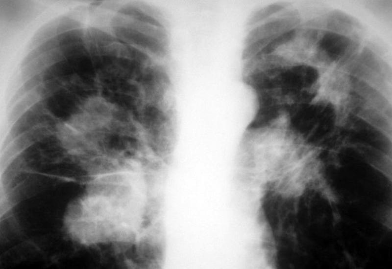 U BiH prošle godine registrirano 698 novooboljelih od tuberkuloze