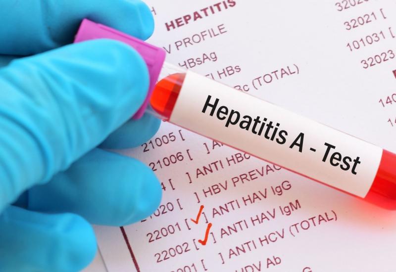 U BiH nema novog hepatitisa, ali je nužan oprez