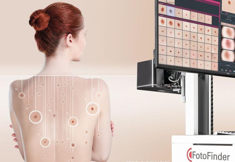 Umjetna inteligencija i kamere visoke rezolucije prepoznaju rak kože u najranijem stadiju