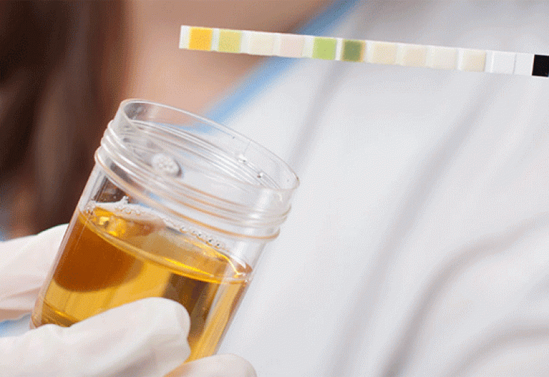 Najnoviji testovi urina mogli bi pomoći u tretiranju raka prostate