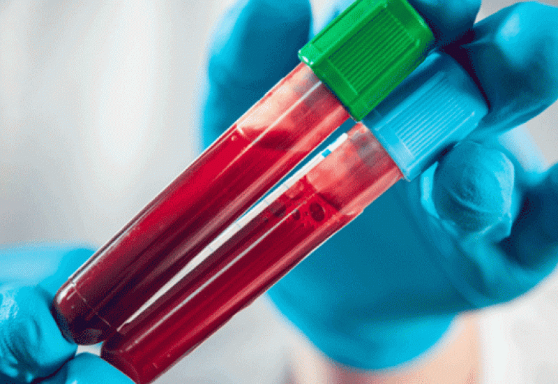 Znanstvenici razvili test krvi koji predviđa šanse za smrt