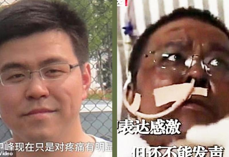 Hu Weifeng (42) i dalje je u teškome stanju - Malo je reći crno pred očima: Kineskim liječnicima iz Wuhana potamnila koža!
