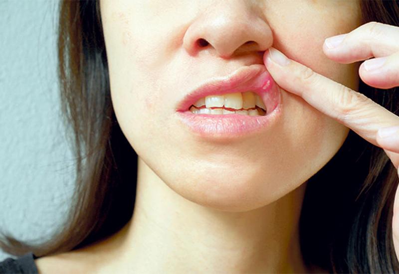 Kućni lijekovi za zacjeljivanje ranica u ustima