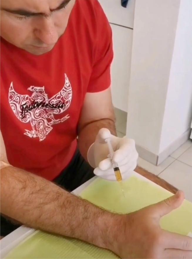 Dr. Beus sam sebi injektira PRF ALPHA zbog De Quervainovog sindroma (bolne upale tetive palca)  - Dr. Branimir Beus: Izliječili smo smrznuto rame