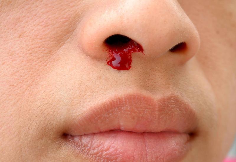 Mnogi pogrešno zaustavljaju krvarenje iz nosa
