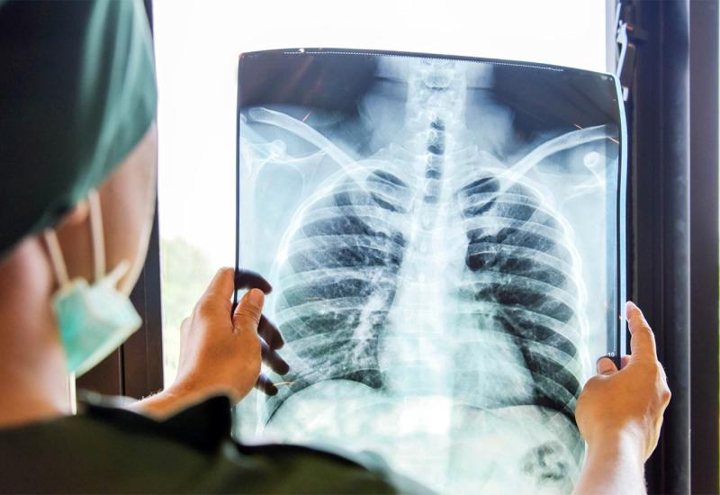Liječnik gleda rendgen pluća - 10 slučajnih izuma koji su promijenili svijet