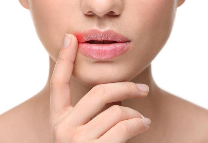Žena dodiruje bolnu usnu - 7 bitnih stvari koje nam usne mogu reći o našem zdravlju