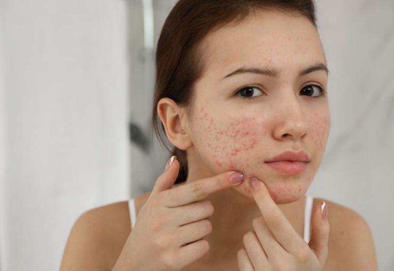 Žena dodiruje akne na licu - Voljeli bi da smo ranije znali ovih 10 trikova za njegu kože