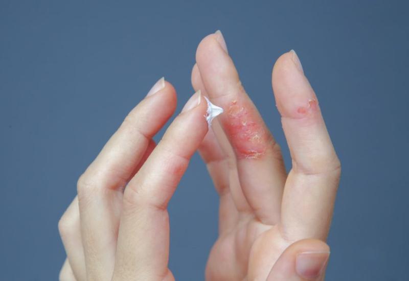 8 najčešćih uzroka pucanja kože na prstima i kako si pomoći 