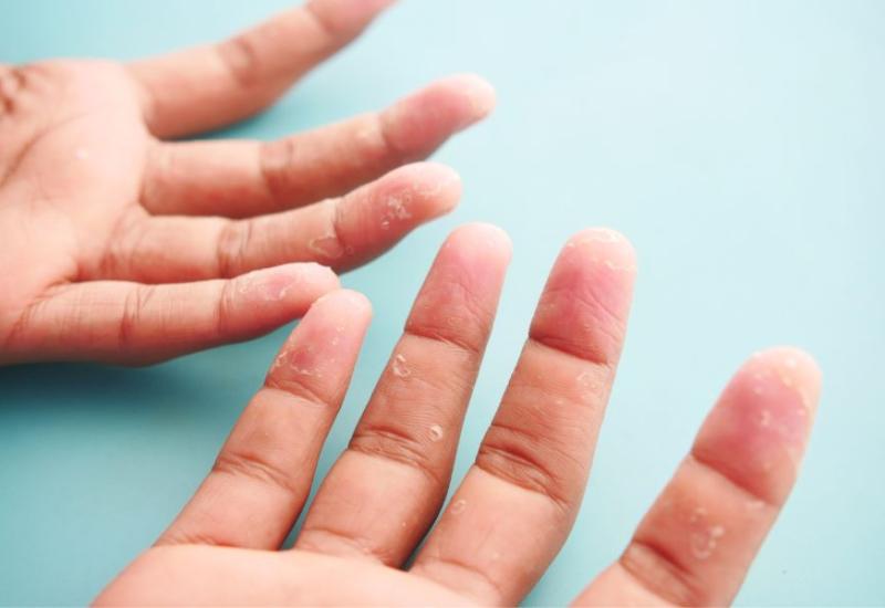Ispucala koža na prstima - 8 najčešćih uzroka pucanja kože na prstima i kako si pomoći 