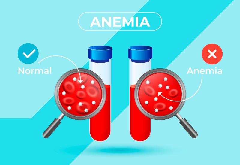 Anemija - Kako prepoznati znakove anemije i reagirati na vrijeme?!